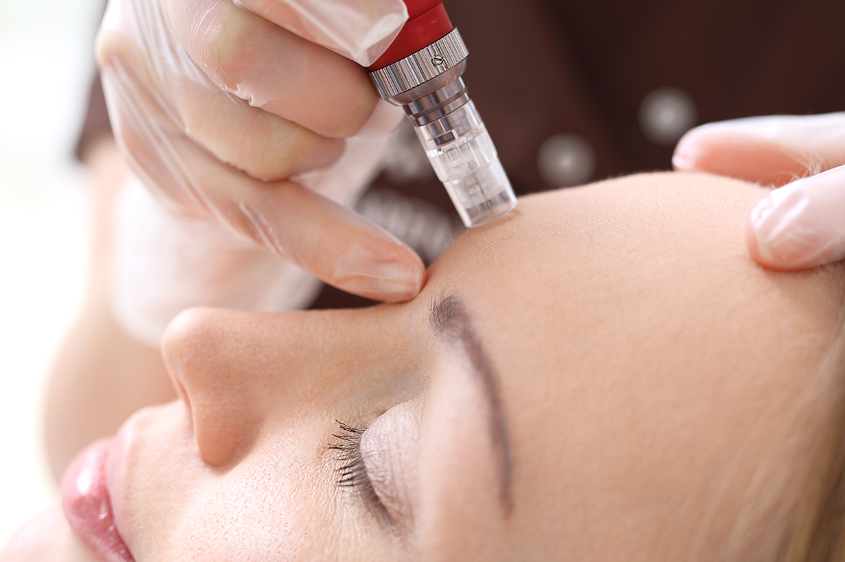 Microneedling - Haven Beauty Lab - Gig Harbor, WA