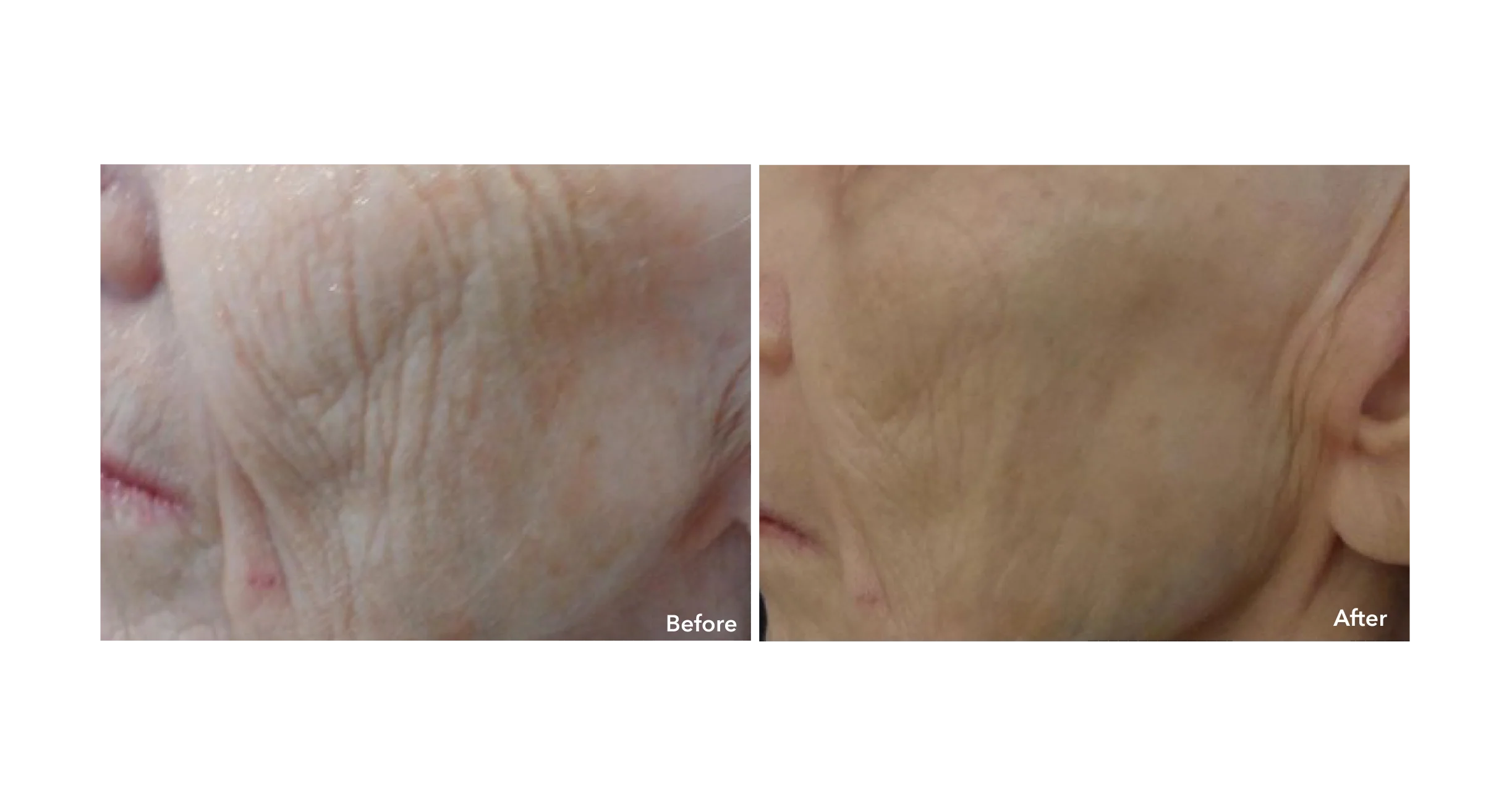 Microneedling - Haven Permanent Cosmetics & Aesthetics