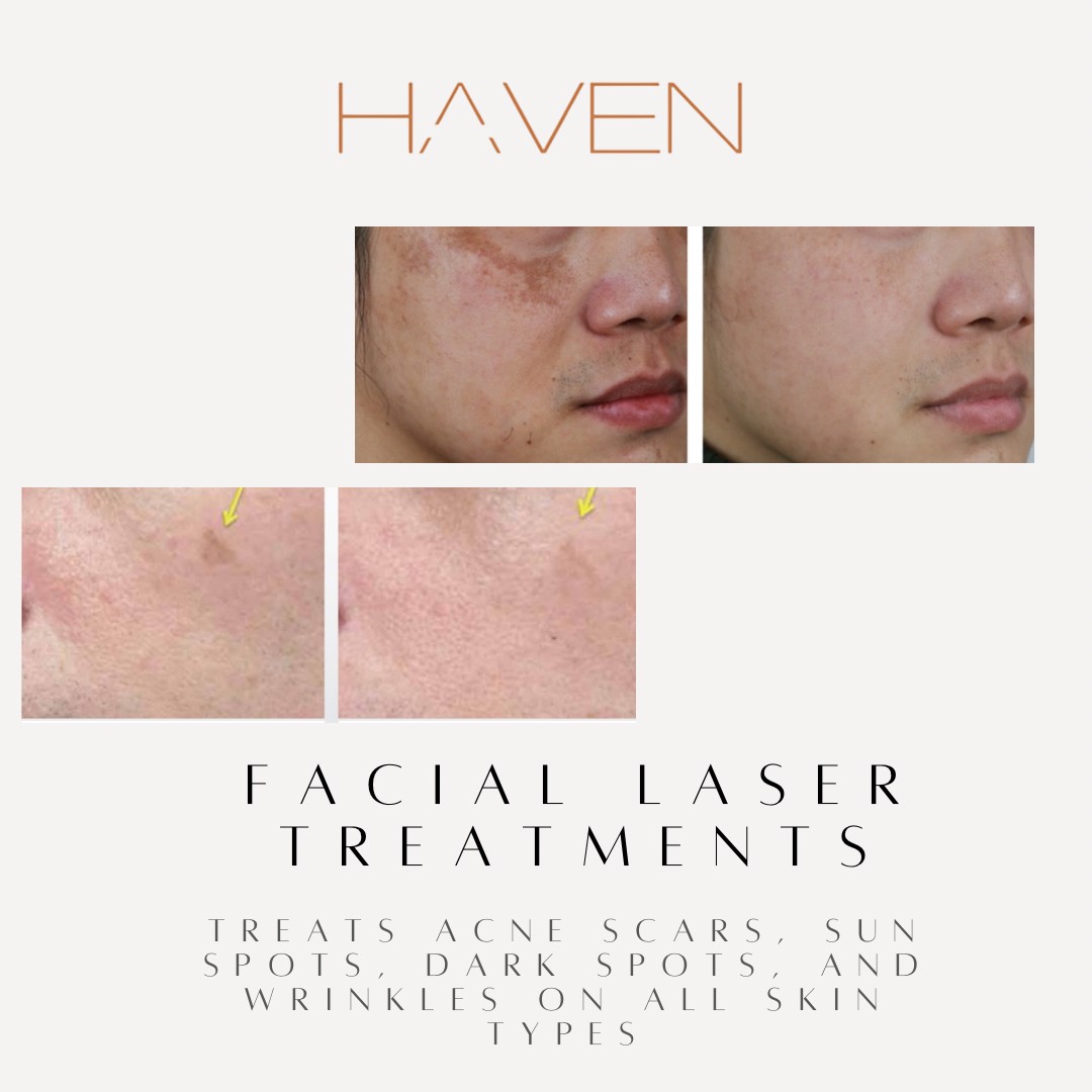 Examples of laser facial scar removal performed by Haven Permanent Cosmetics