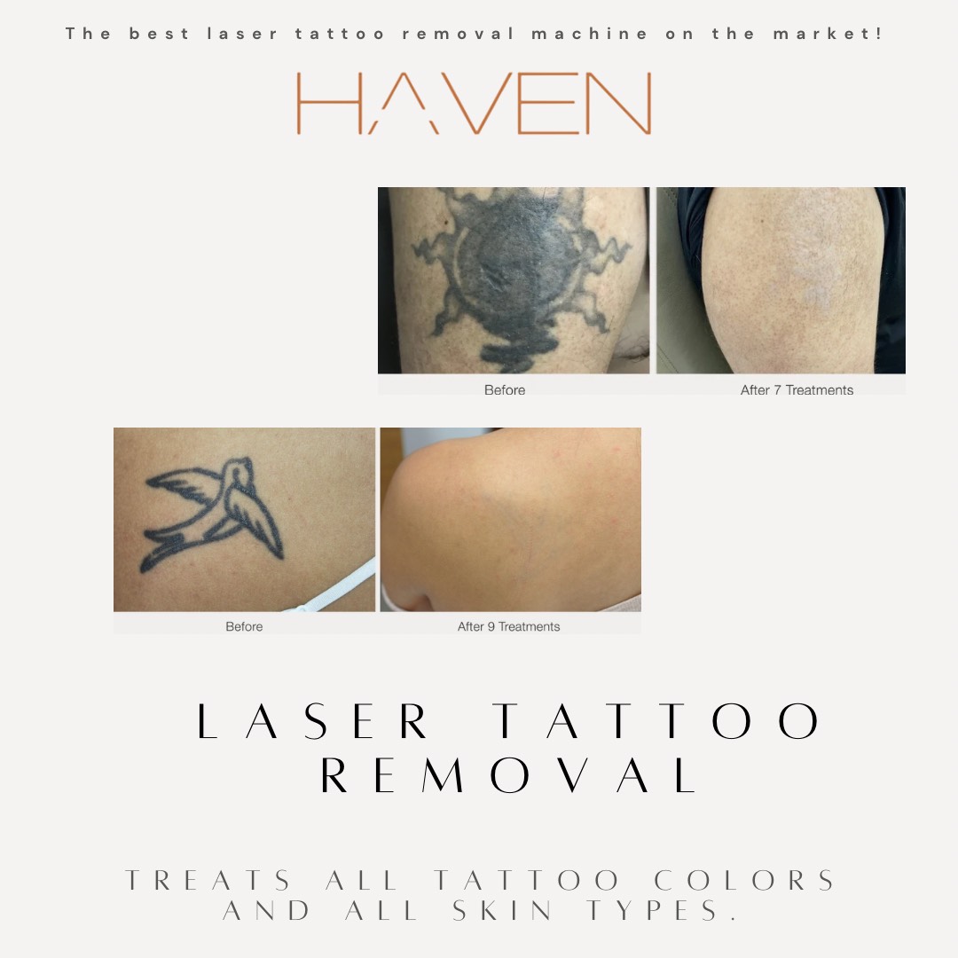 Examples of successful tattoo removal being performed at Haven Permanent Cosemetics