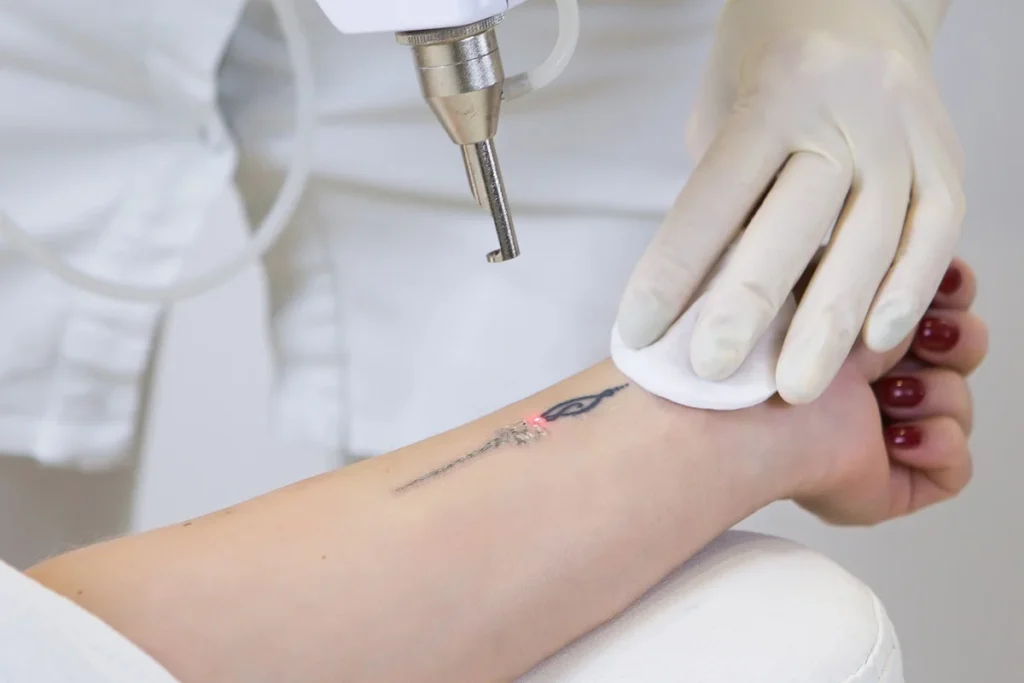 Laser tattoo removal at Haven Permanent Cosmetics & Aesthetics in Gig Harbor, WA