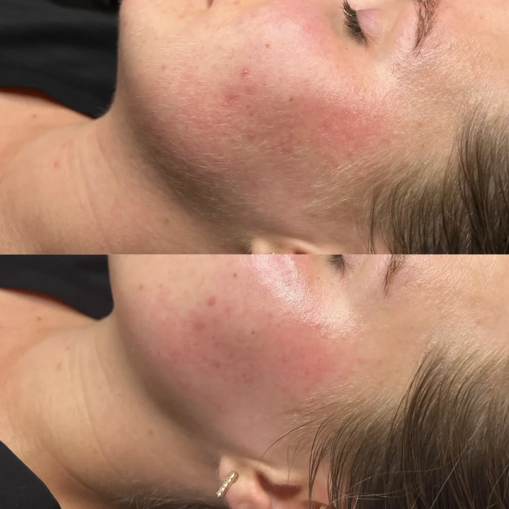 Dermaplane Before & After