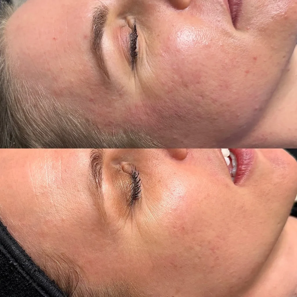 Hydrafacial Before & After 1