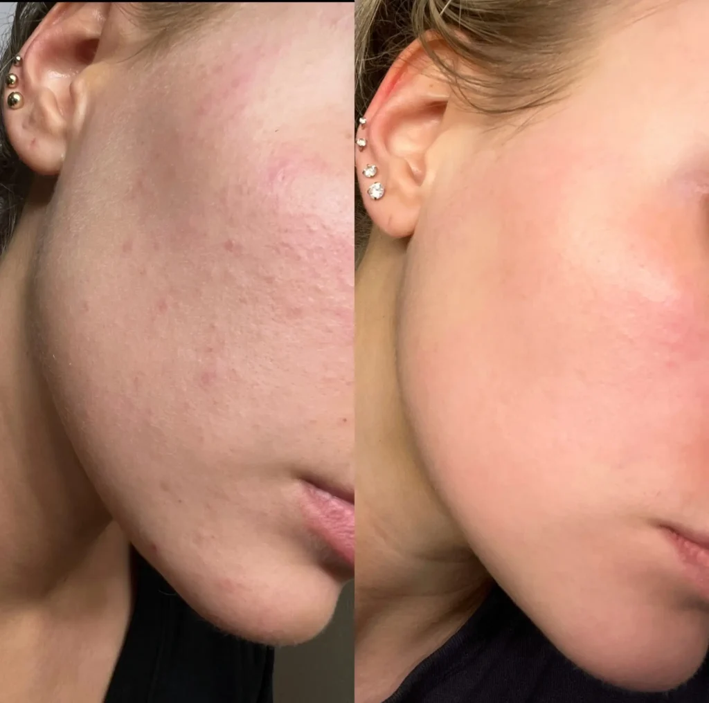 Monthly Memberhsip Facials + Dermaplane Before & After