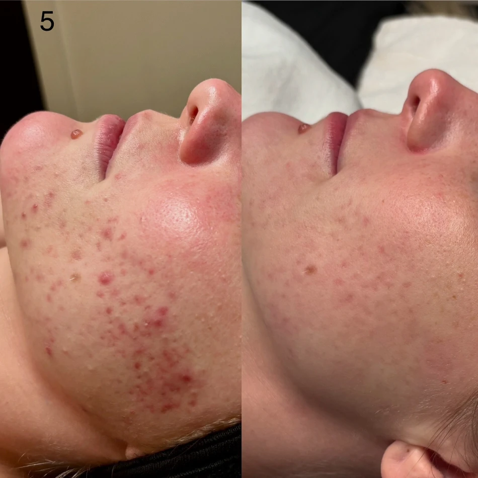 Acne Boot Camp - 6 Months