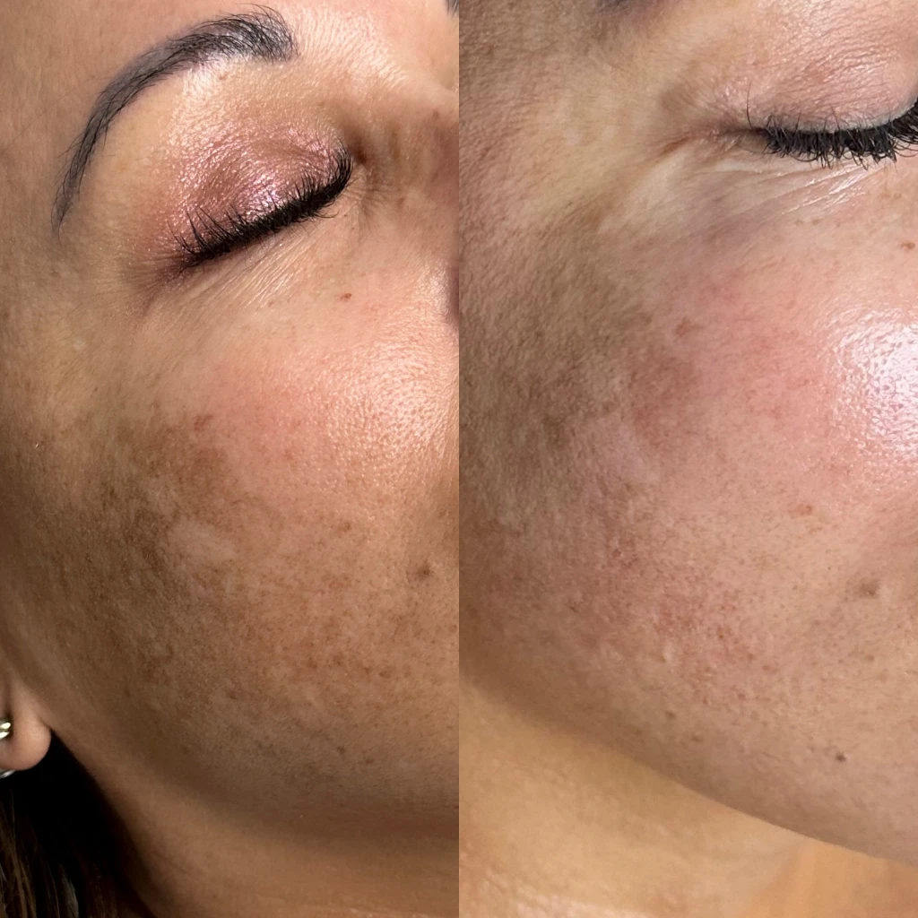 Microneedling + Monthly membership HydraFacial