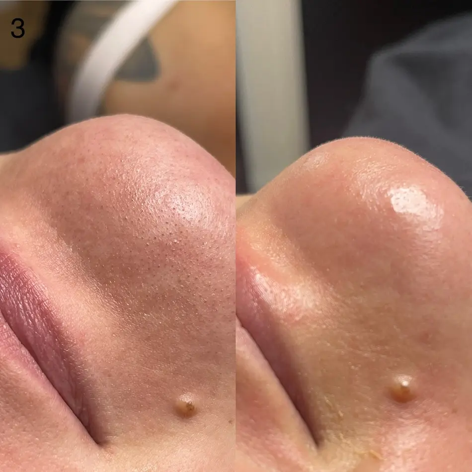Dermaplane before & After