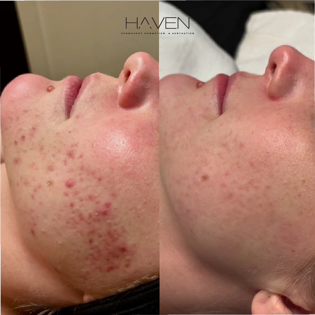 Acne Boot Camp - 6 Months