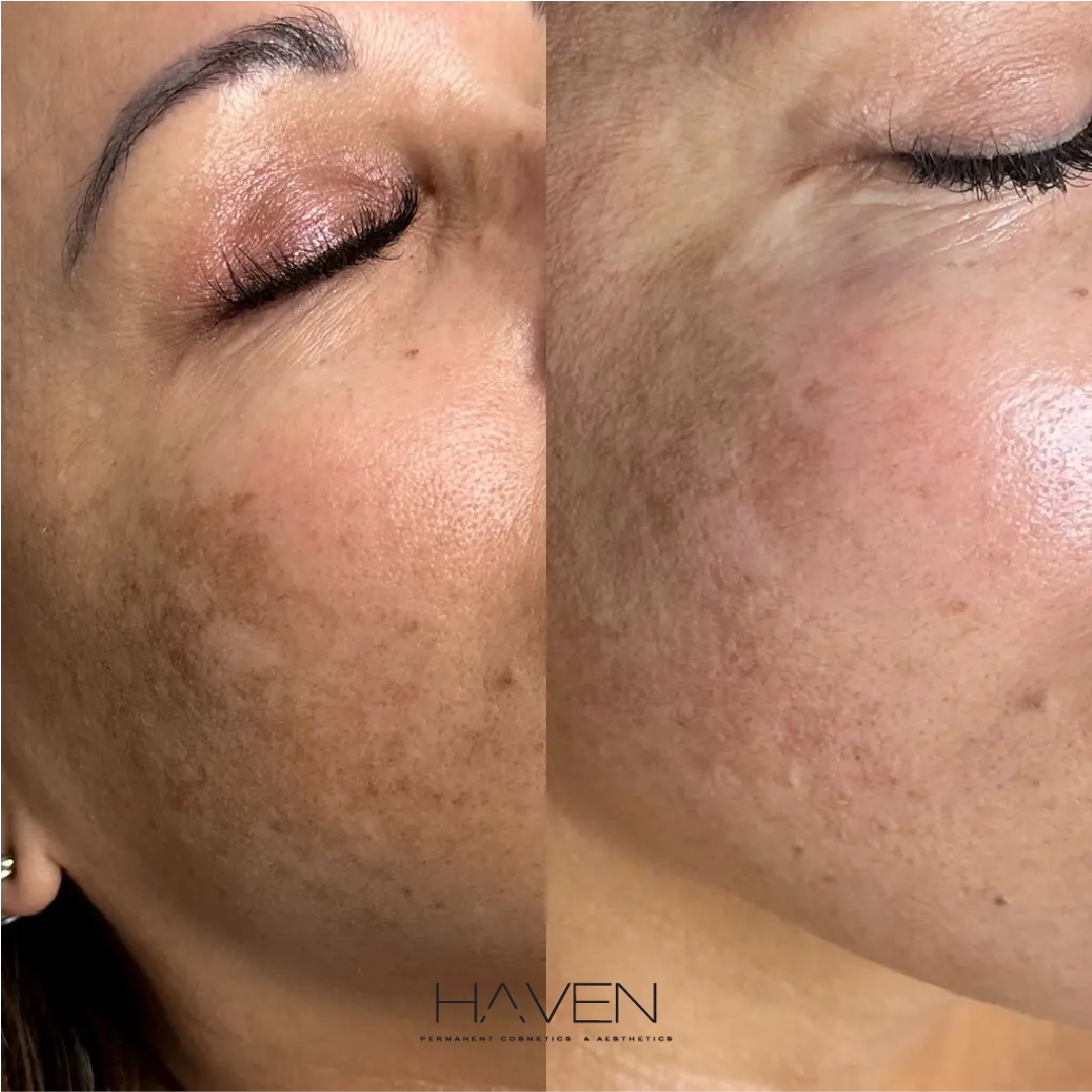 Microneedling + Monthly membership HydraFacial