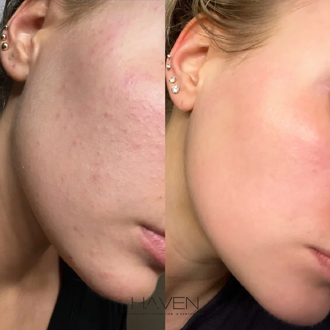 Monthly Membership Facials + Dermaplane