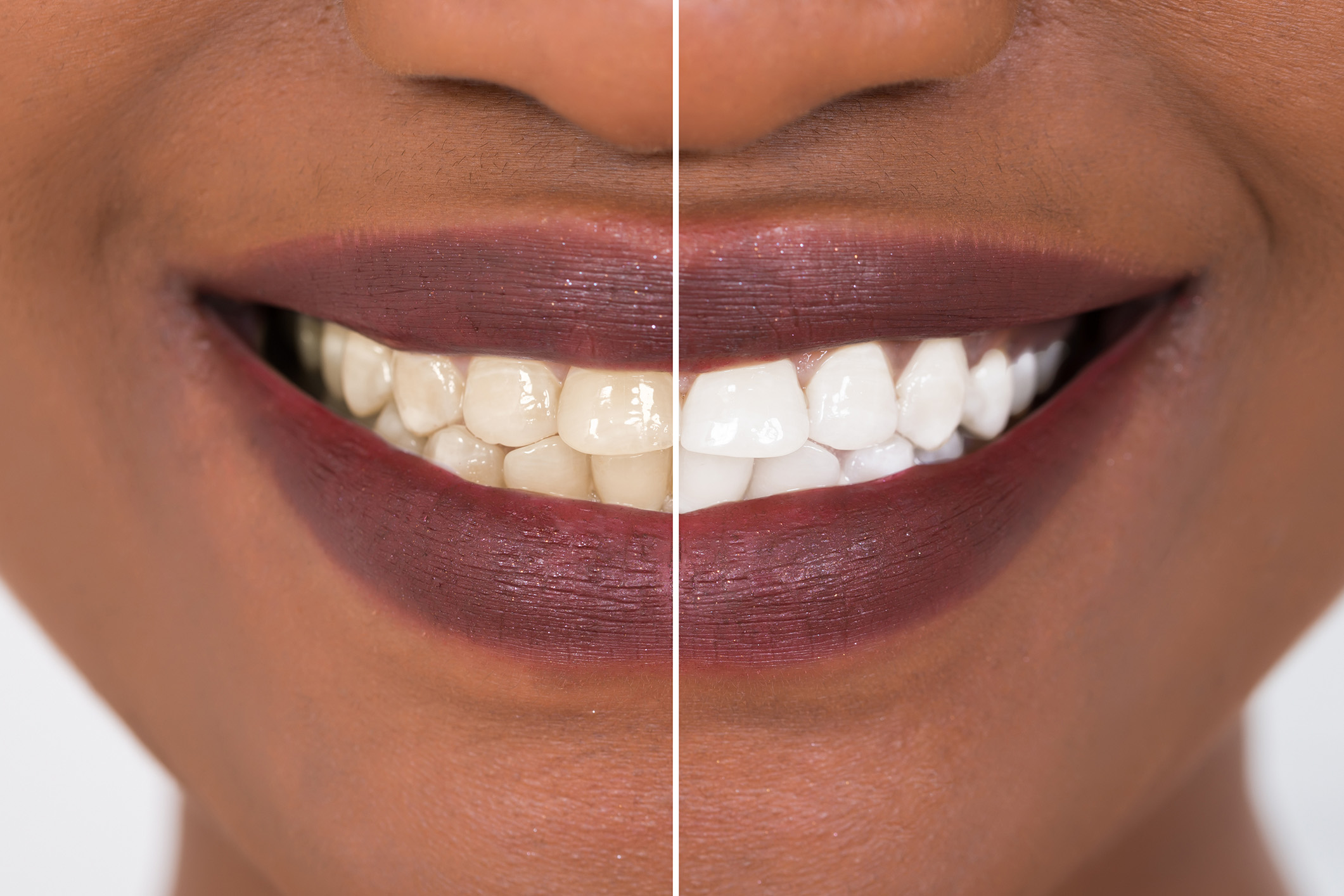 Cosmetic Teeth Whitening at Haven in Gig Harbor, WA
