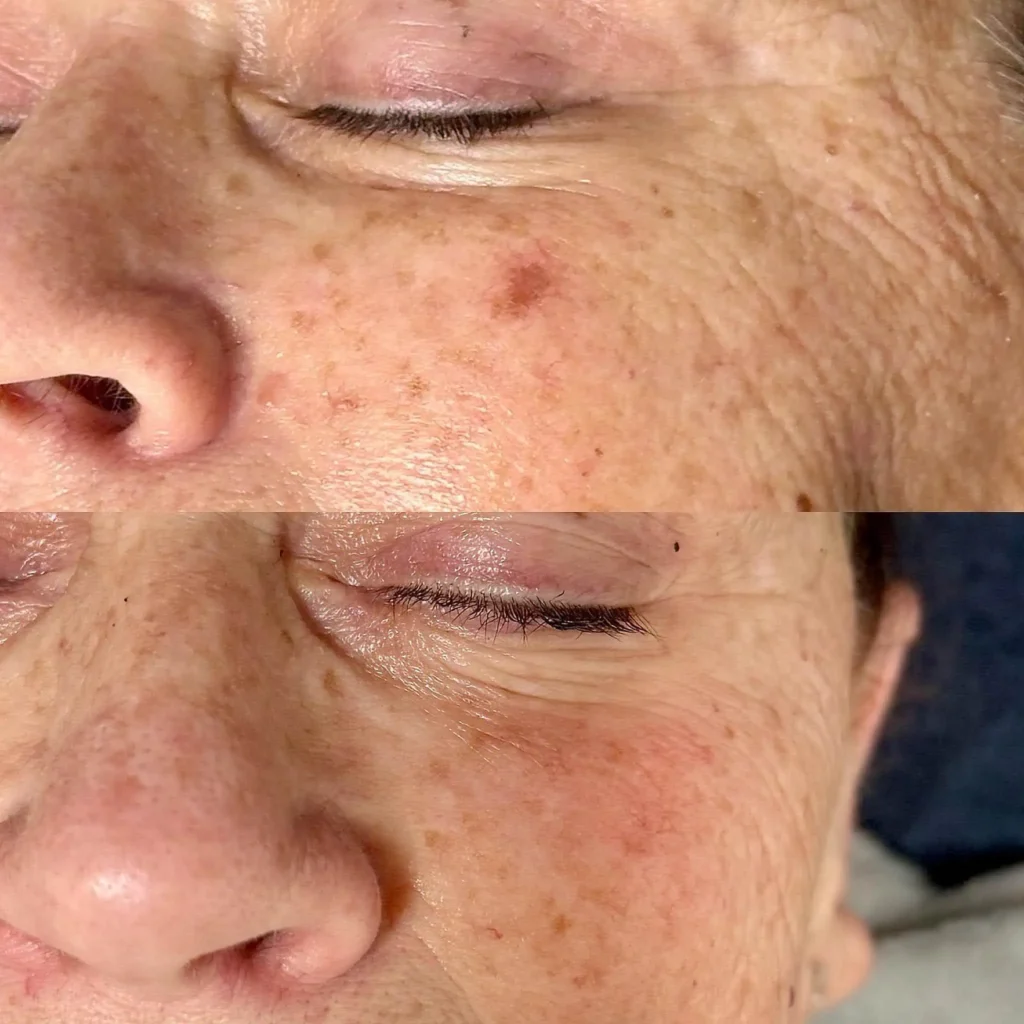 Before and After results Resolve Spot Treatment at Haven Permanent Cosmetics & Aesthetics in Gig Harbor, WA