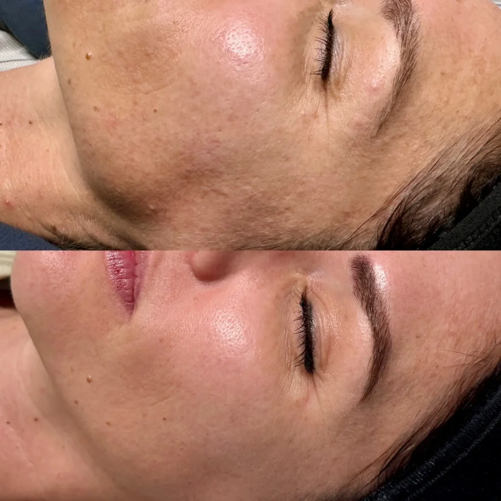 3 sessions Microneedling + 3 sessions Full face Resolve Laser before and after results by Jorden of Haven Permanent Cosmetics & Aesthetics in Gig Harbor, WA