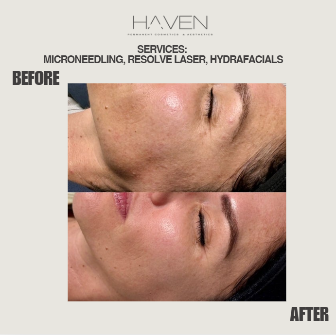 Female client's Microneedling, Resolve laser, and hydrafacial treatment before and after results at Haven Permanent Cosmetics & Aesthetics in Gig Harbor, WA