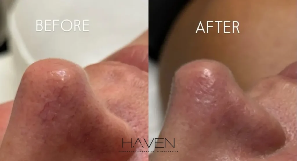 Vascular Laser Treatment Before and After results at Haven Permanent Cosmetics & Aesthetics in Gig Harbor, WA