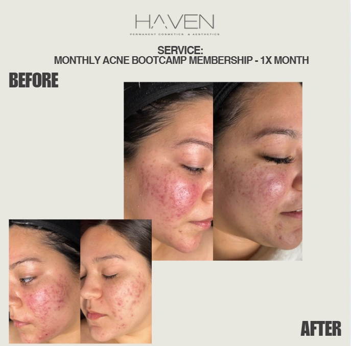 Monthly Membership female client's Acne bootcamp treatment before and after results at Haven Permanent Cosmetics & Aesthetics in Gig Harbor, WA