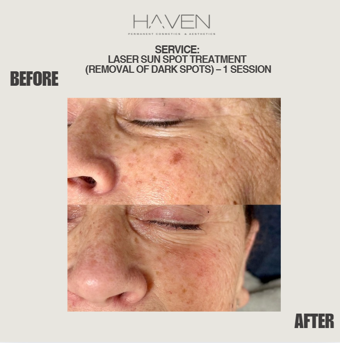 Female client's Laser sun spot treatment (Removal of Dark spots) 1 session before and after results at Haven Permanent Cosmetics & Aesthetics in Gig Harbor, WA